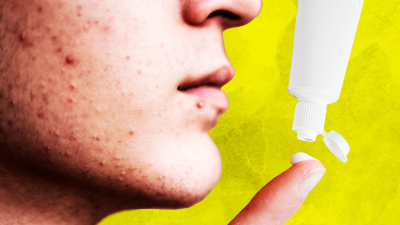 Pasta de dientes y espinillas en la cara: ¿remedio casero infalible o mito urbano?
