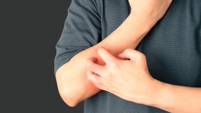 Dermatitis Atópica: La enfermedad crónica de la piel que puede aumentar sus efectos debido a la transpiración