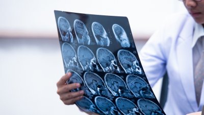 ¿Cómo reconocer un accidente cerebrovascular a tiempo? Claves para actuar rápido y salvar vidas