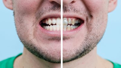 Los riesgos de utilizar los blanqueadores dentales que se venden por internet