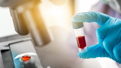 Científicos desarrollaron test para detectar cáncer de páncreas a través de una muestra de sangre